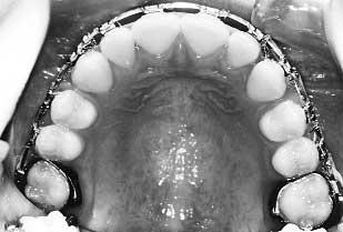 With modern medicaments and pulp management techniques, it should be possible to delay extractions and keep first molars in almost every case that will direct the second molars into their normal