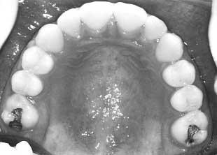 Arch Wire Problems The long span of arch wire between the second premolar and the second molar