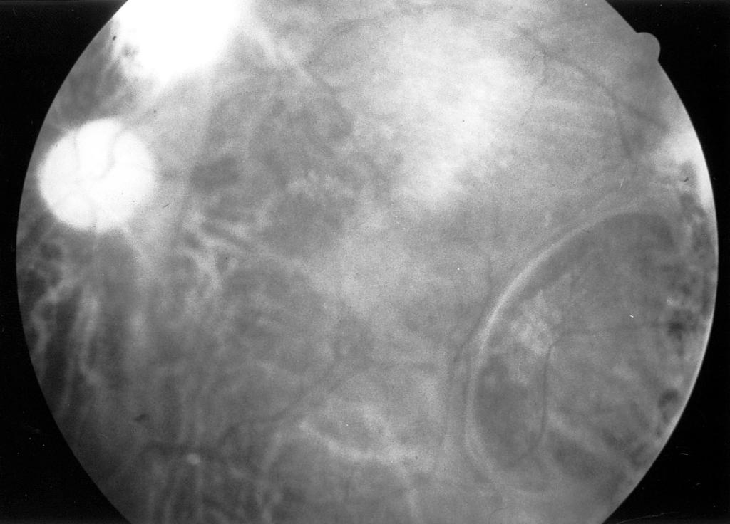 838 Chiun-Ho Hou, et al Fig. 2 Fundus photography of Patient 2 at 1 year after surgical treatment. The retina is well attached and the macular pucker is noted. retinal traction.