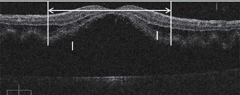 The mean duration of macular detachment was 15.5 ± 15.2 days (range, 1 to 60 days), with 30 days or less in 26 (83%) patients.