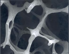 Osteoporosis: THEN and NOW Images courtesy of