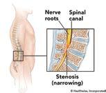 Stenosis in the spine is the narrowing of the bony canal that surrounds the nerves. It may result from trauma or as a normal part of aging.