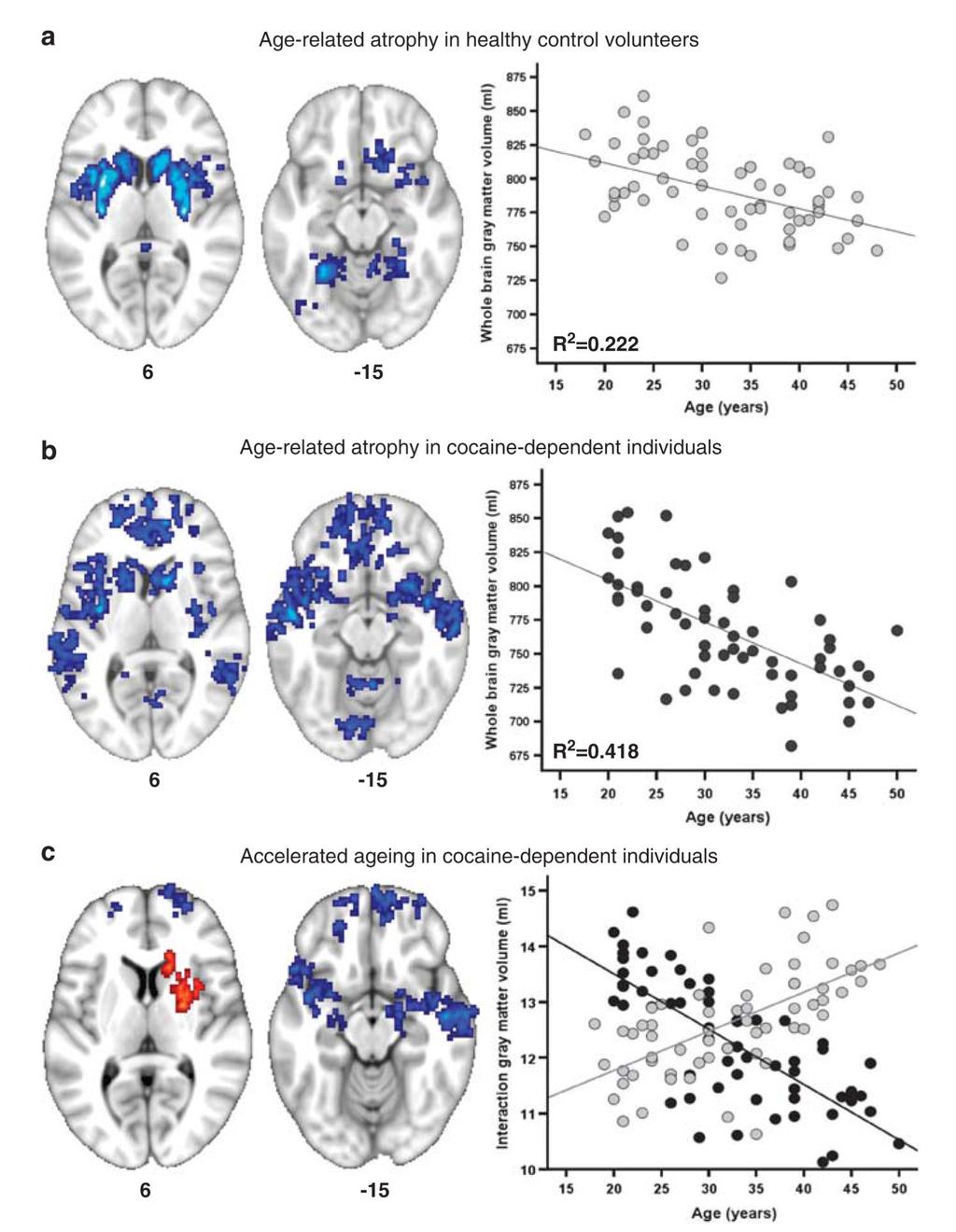 Ersche et al. Page 4 Figure 1. Age-related changes in gray matter volume in 60 healthy volunteers and 60 cocainedependent individuals.
