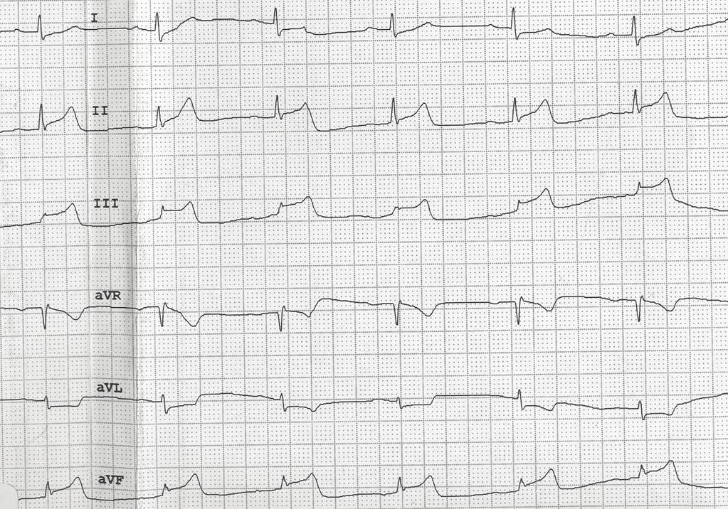 312 Clinical Predictors of Incomplete ST Resolution Fig. 1. ECGs of a patient with inferior STEMI on admission showing grade 3 ischemia.