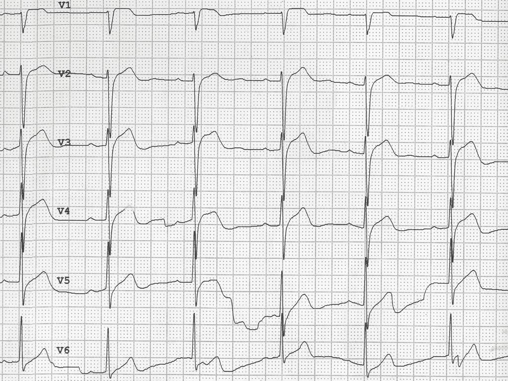 ECGs of a patient with anterior STEMI on admission showing grade 2 ischemia. A ST-segment elevation in V1-4 is evident.