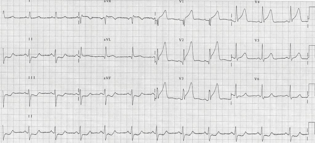 rameters: hypertension, duration of the chest pain, location of myocardial infarction, Killip Class, ischemia grade on ECG at the admission, initial level of troponine I and brain natriuretic peptide