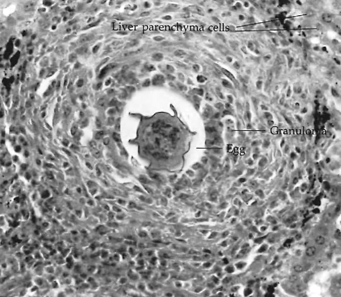 MORPHOLOGY 203 FIGURE 11-6 Schistosoma mansoni egg in liver granuloma. The free-swimming miracidium (Fig.