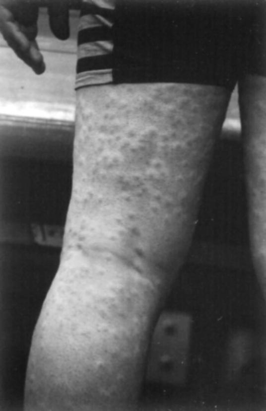 210 11. BLOOD FLUKES FIGURE 11-12 Swimmer s itch. Note the inflammatory reaction on the leg. exposure to the infective stage.