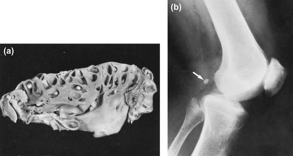 HUMAN CYSTICERCOSIS 255 FIGURE 14-3 Human cysticercosis. (a) Heart containing cysticerci of Taenia solium. (b) Taenia solium cysticercus close to bone (arrow).