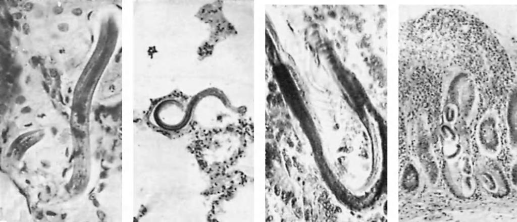 306 16. INTESTINAL NEMATODES (a) (b) (c) (d) FIGURE 16-9 Strongyloides stercoralis. (a) Filariform larva in skin. (b) Larva in lung. (c) Adult and (d) eggs in mucosa of duodenum.