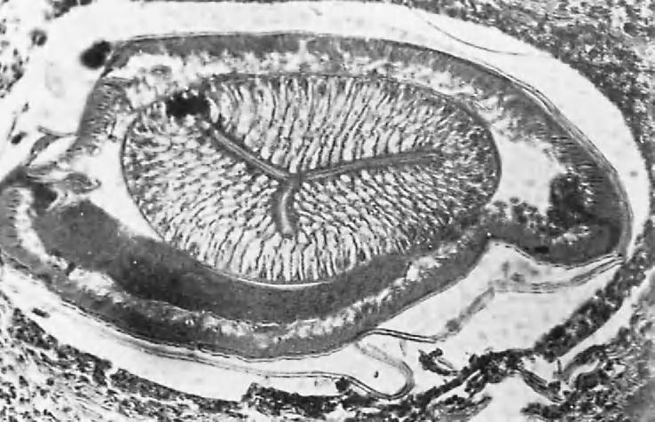 HUMAN HOOKWORM DISEASE 323 FIGURE 16-19 intestine. Light micrograph of a section through the esophagus of an Anisakis larvae in the human the infective larvae are ingested by the host.