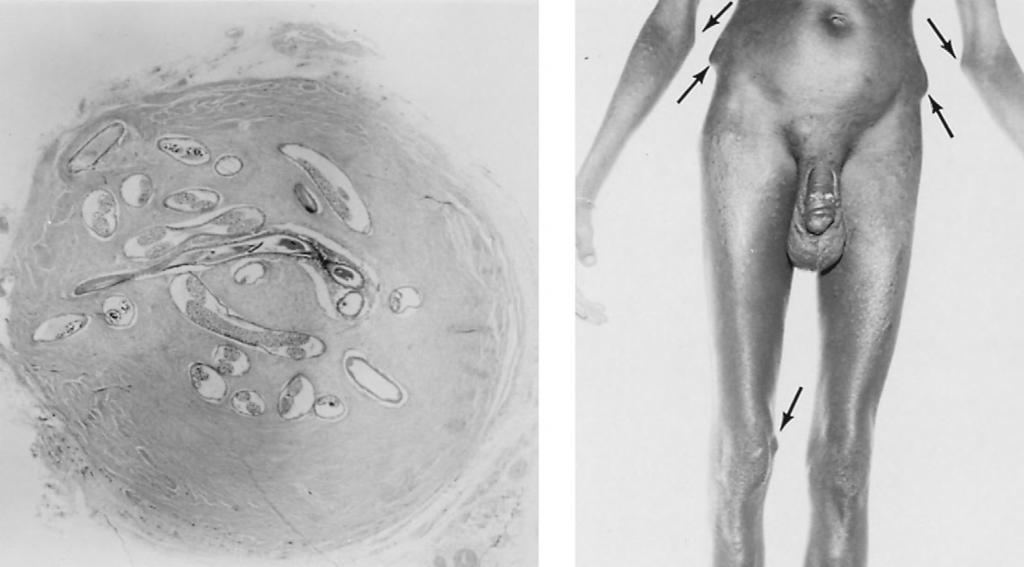 FILARIAL WORMS 337 FIGURE 17-4 Onchocerca volvulus. (left) Section through a nodule showing adult worms with microfilariae. (right) Onchocercomas on a native in the Congo.