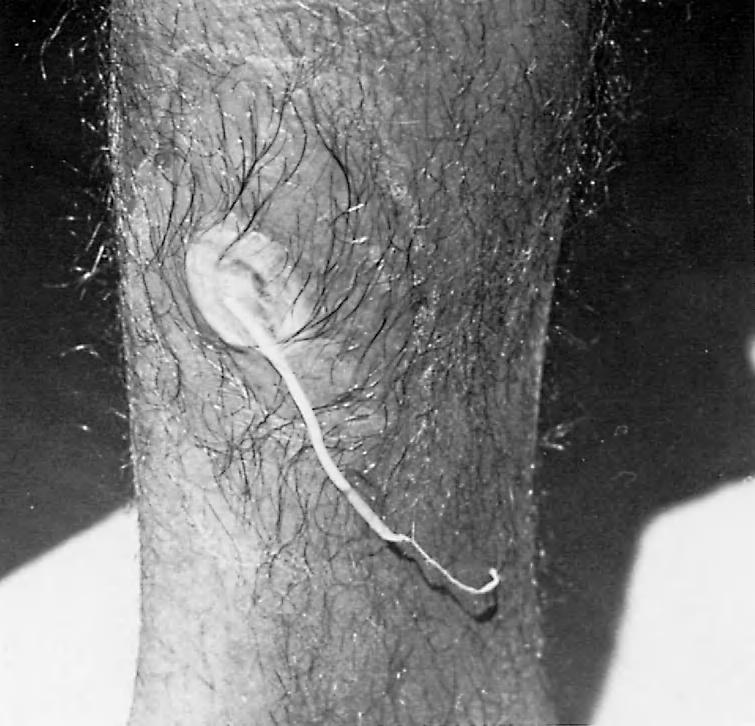 342 17. BLOOD AND TISSUE NEMATODES FIGURE 17-6 Female Dracunculus medinensis partially protruding from blister on leg. months after infection.