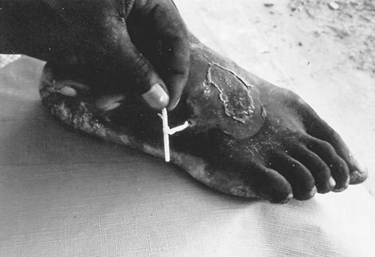 THE GUINEA WORM 343 FIGURE 17-7 Female Dracunculus medinensis slowly being withdrawn from ulcer on foot with twig. species of Dracunculus with which D.