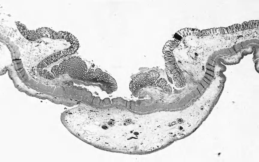 The overlying mucosal epithelium then may be sloughed off, exposing these necrotic areas (Fig. 4-3).