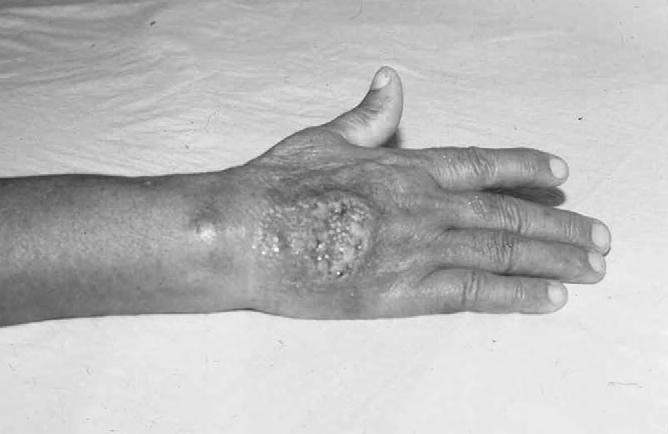 Symptomatology and Diagnosis MORPHOLOGIC FORMS 99 In humans, the initial sign of the infection is the appearance of a vascularized papule or nodule on the skin at the feeding site of the insect.