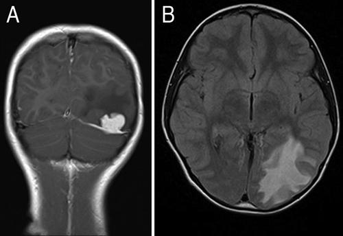 P. A. Grabb cits. His visual fields were normal. An occipital lesion based on the tentorium was diagnosed preoperatively (Fig. 1). The lesion enhanced brightly and was sharply circumscribed.
