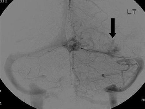 Intracranial capillary hemangiomas in children Fig. 2. Case 1. Anteroposterior left vertebral artery angiogram, capillary-venous phase, showing persistent blush (arrow) of a left tentorial lesion.