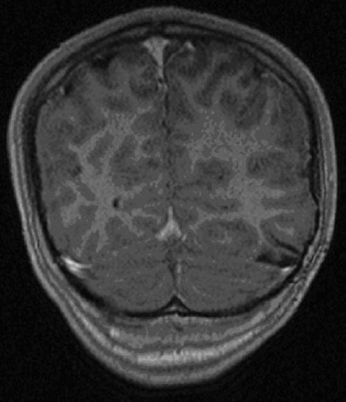 Despite preservation of the major sylvian vasculature, complete removal of the lesion, and evacuation of the hematoma, the brain swelling remained profound.