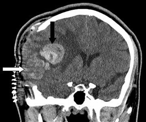 Coronal noncontrast cranial CT scan obtained after halting operation showing the unresected mass (white arrow) and new hematoma (black arrow) from spontaneous intraoperative bleeding.