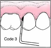 calculus Defective margins of restorations Code 2 Dental biofilm control instruction Complete preventive care Calculus removal Correction of irregular margins of restorations Code 3 Colored area of