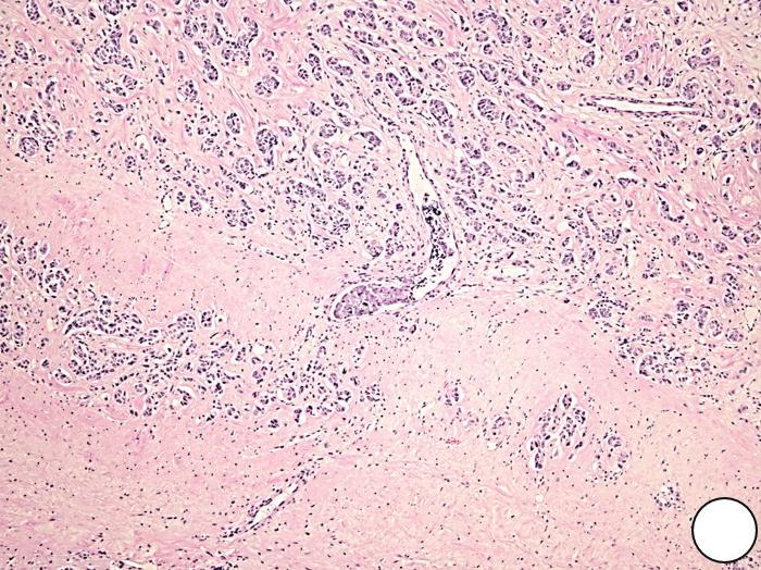 Predictive Value in Pituitary Adenoma 423 A B C D Fig. 2. Microscopic findings of a pituitary carcinoma case with metastasis to the distant cerebrum and skull.