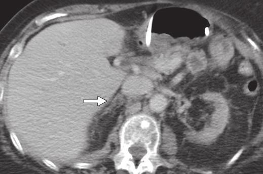 , xial contrast-enhanced CT image shows mass of soft-tissue attenuation in left adrenal gland and swollen and hypoenhancing right adrenal gland (arrow).