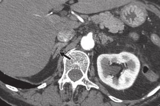 , xial contrast-enhanced CT image obtained 1 week before appendectomy shows normal right (arrow) and left adrenal glands, confirming changes in are due to hemorrhage.