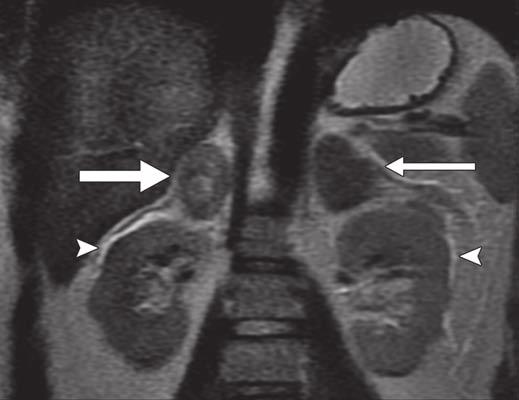 xial contrastenhanced CT image shows new mild bilateral adrenal enlargement (CT 3 months earlier showed normal adrenal glands) with peripherally preserved enhancement (train-track appearance), which