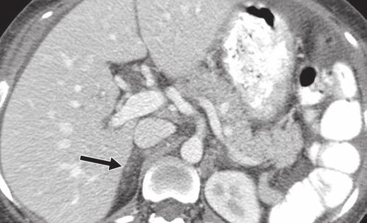 Evolution of MRI findings was considered diagnostic of bilateral adrenal hemorrhage. iochemical evaluation showed no features of pheochromocytoma.