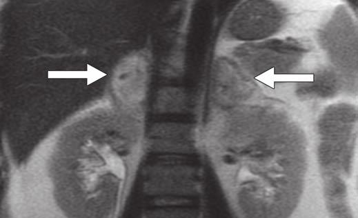 preserved peripheral enhancement. Findings are typical of adrenal hemorrhage.