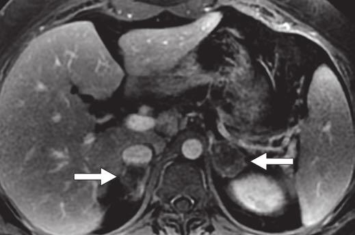 6 30-year-old woman with continued nausea, vomiting, and abdominal pain after cholecystectomy.