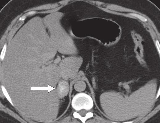 Further testing revealed antiphospholipid syndrome. Fig. 7 36-year-old man undergoing adrenal vein sampling.