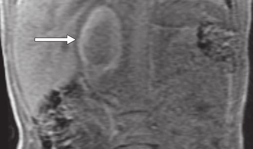 , xial PET image 1 month after shows focal hypermetabolism (arrow) at periphery of right adrenal lesion, concerning for tumor.