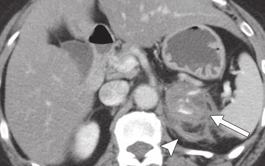Mass may represent adrenal hematoma, but right adrenal gland (arrow) separate from lesion is evident.