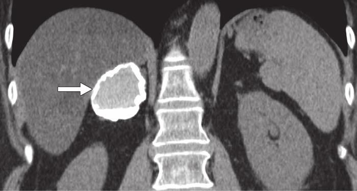 On further questioning, patient reported contrast material had been injected into abdominal cyst 30 years before. Downloaded from www.ajronline.org by 37.44.192.