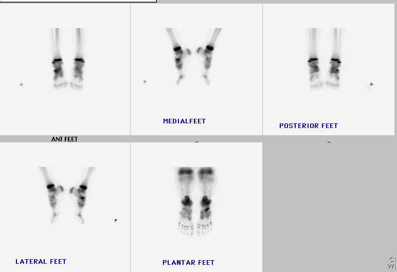Our Patient 2 Bone Scan Focal Areas of