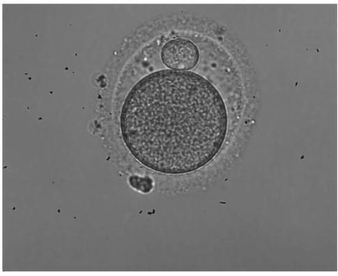 Figure 1. Performing intracytoplasmic sperm injection by positioning the polar body at 12 o clock. Figure 2. Oocyte with enlarged polar body prior to intracytoplasmic sperm injection.