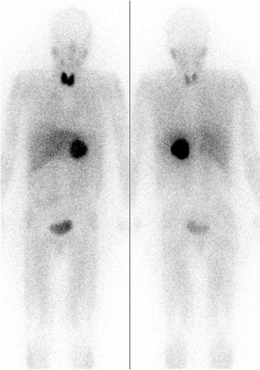 Pheochromocytoma - Imaging CT scan MRI MIBG scan CT most cost-effective, MRI more sensitive, and MIBG more specific MIBG indications Risk for multiple tumors, extra-adrenal tumors, metastases