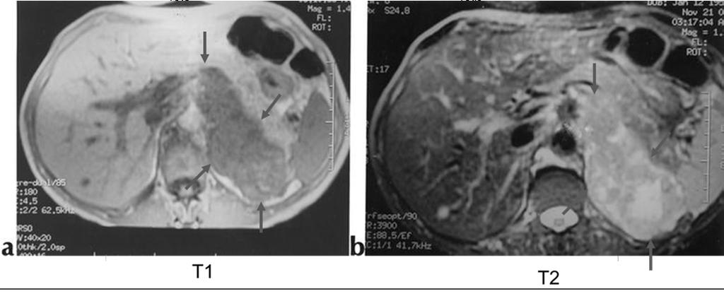 MRI Equally Effective As CT Adenomas Are Iso-Intense With The Liver On T2-weighted