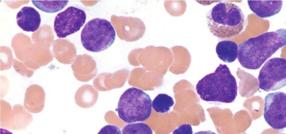 2 Case Reports in Hematology Figure 1: Bone marrow aspirate smear from patient #1, Wright-Giemsa, 1x. and thrombocytopenia, with a white cell count (WBC) at 118.8 thousand/μl and 73% lymphoid cells.