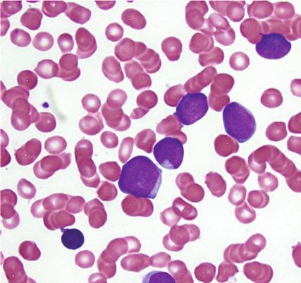control (HL6 cell line). Figure 5: Bone marrow aspirate smear from patient #2, Wright-Giemsa, 1x. often carries an abnormal karyotype and an unfavorable prognosis.