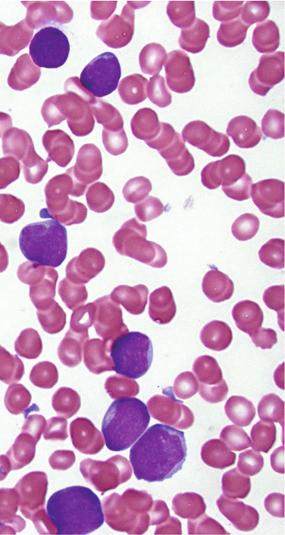 Numerous genes have been implicated for the pathogenesis and prognosis for T-ALL, including NOTCH1, TAL1, and HOX1 [5, 14]. γδ T-ALL is a rare variant of T lineage lymphoblastic leukemia/lymphoma.