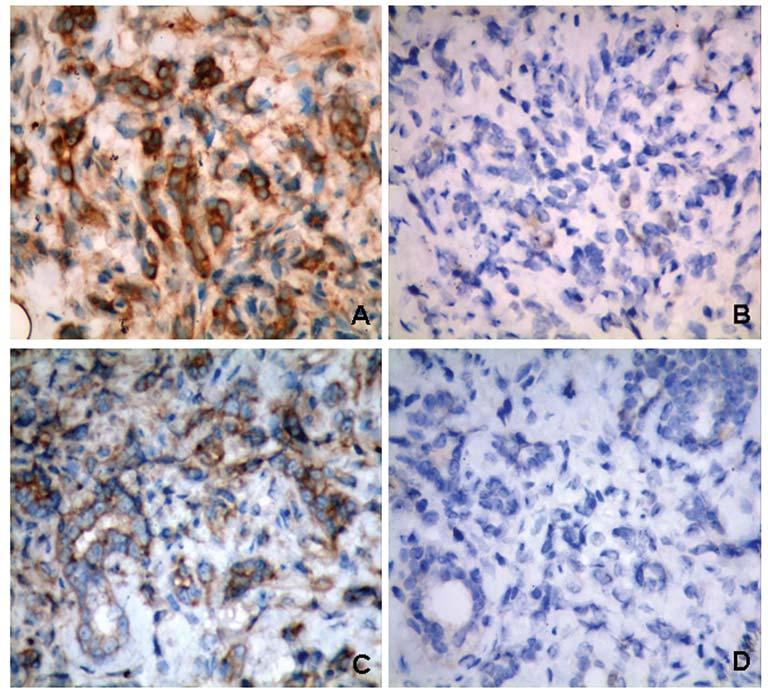 Figure 3. Immunohistochemistry demonstrating ER- 36 and ER- 66 expression in two breast cancer cases.