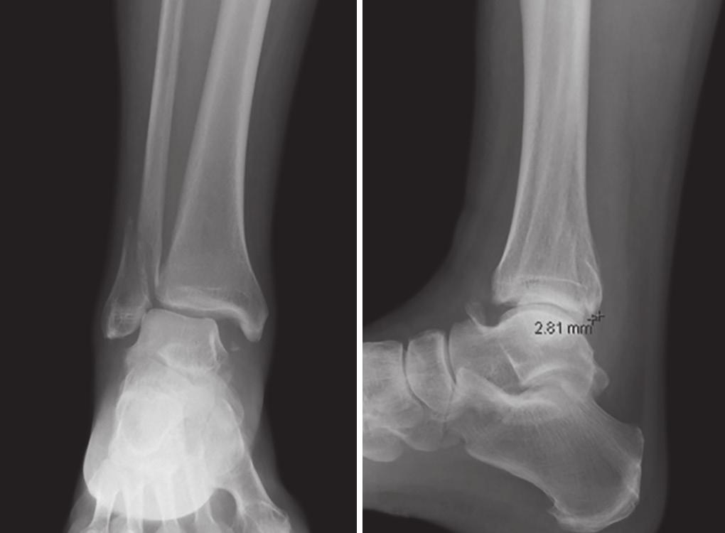 Andrew P Matson et al fractures. 12,13 We present data to suggest that short-term, interim reduction stability is associated with PM fracture fragment size. When PM fracture fragment ratio was >0.