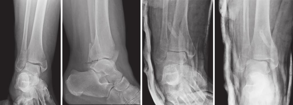 de Vries et al 12 report that relative PM fragment size is greater in fracture dislocations than in nondisplaced fractures, which is consistent with our finding that PM fragment size is associated