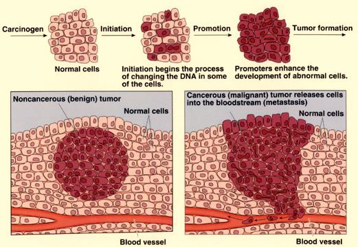 Gene Regulation - 15 From what we know today, the steps in cancer development include: Exposure to a carcinogen from the environment by ingestion, inhalation, etc.