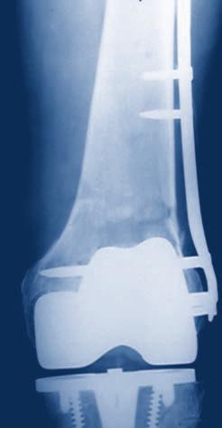 Indications Indications LCP DF is indicated for the stabilization of fractures of the distal femur.