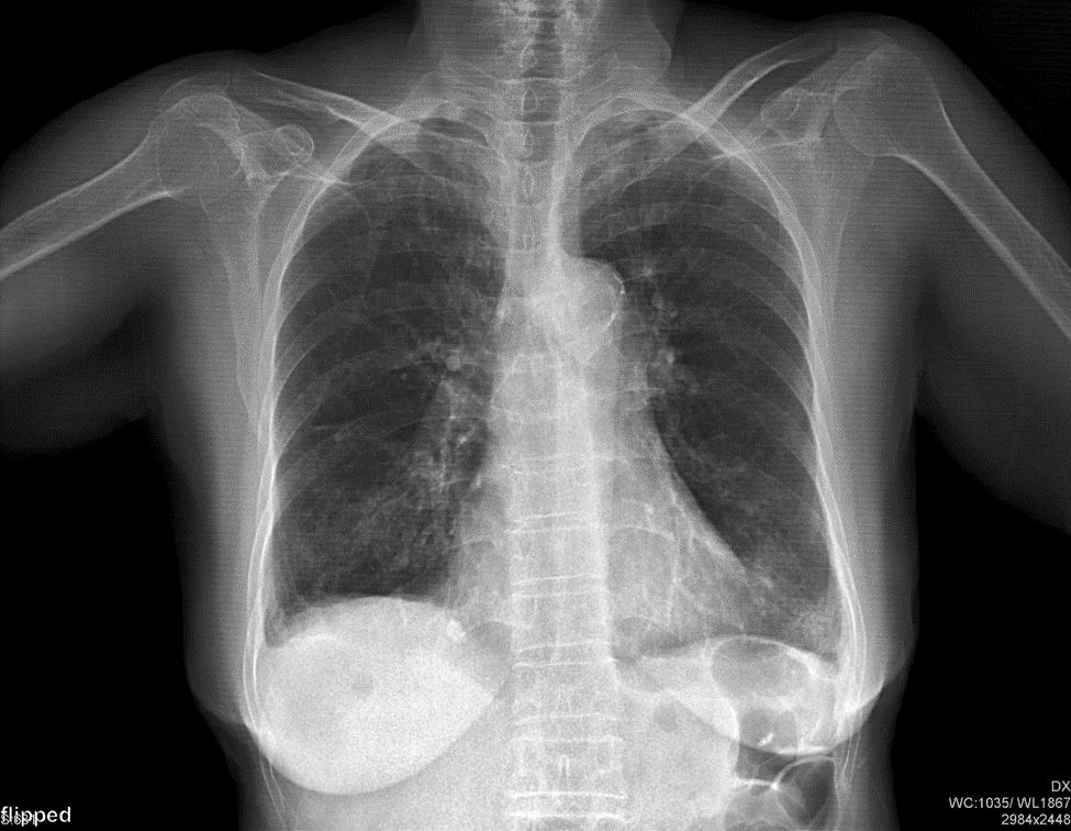 76/F, cough 2 weeks, non-smoker, weight loss, fever, no DM, previous TB treatment (1965) CXR (3 readings):