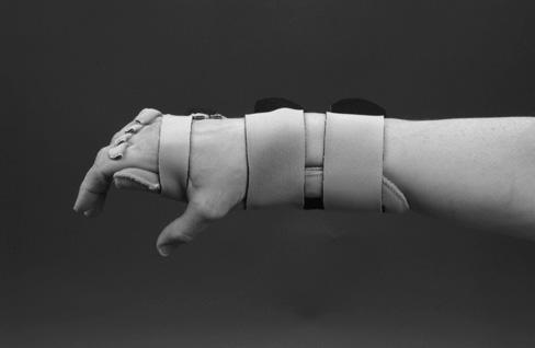 The padding placed just radial to the head of the metacarpal of the index finger helps maintain the wrist in a relatively neutral, frontal plane position.